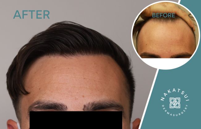 FUE hair transplant edmonton before and after cover photo