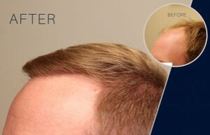 hair transplant before and after 2570 grafts