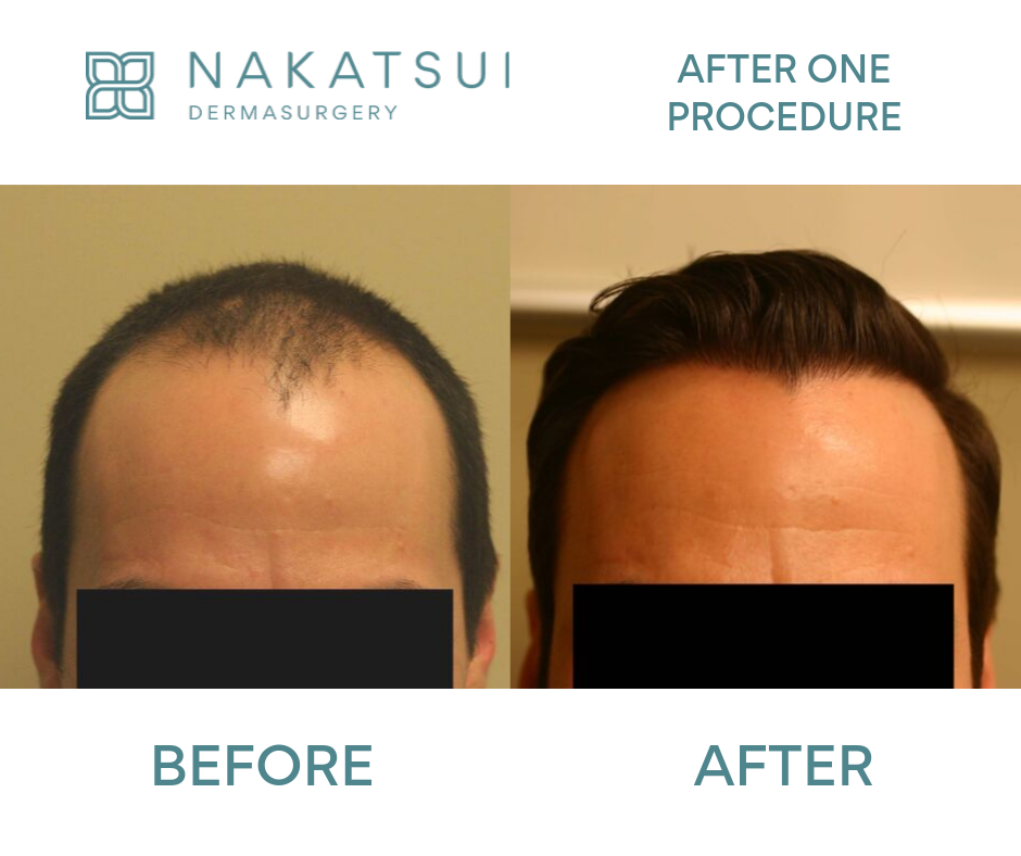 before and after frontal view hair restoration