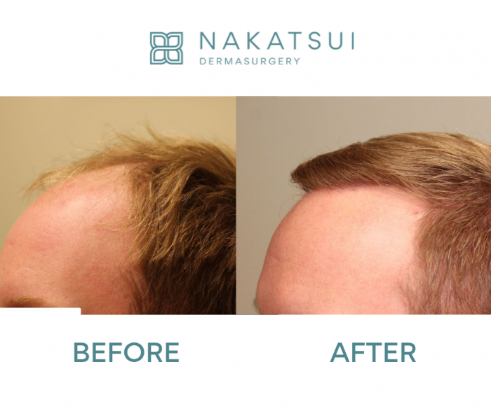 Ultra-refined Hair Transplant Edmonton | Nakatsui Hair Transplant :