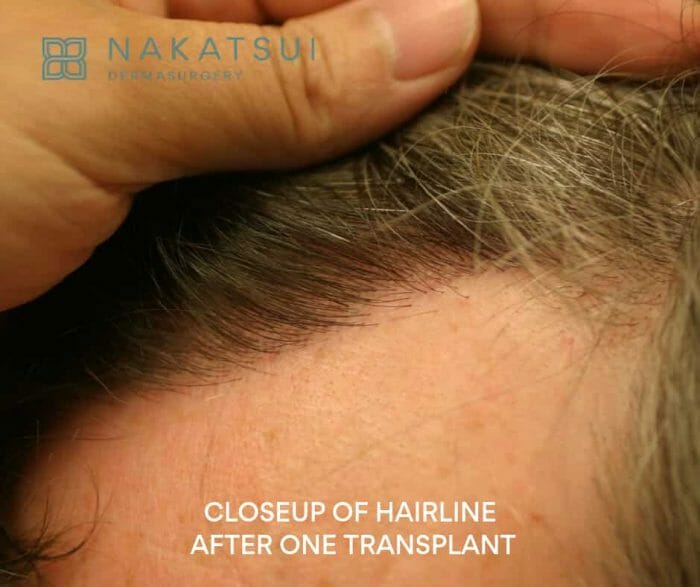 hairline before and after FUT hair transplant