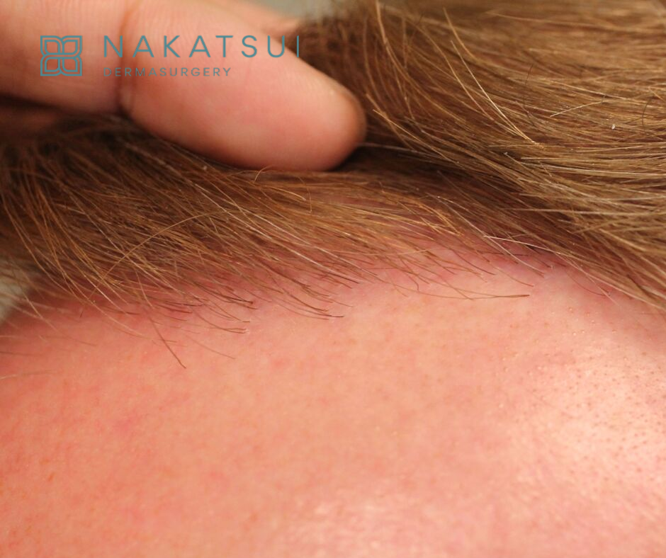 close up of hairline hair transplant