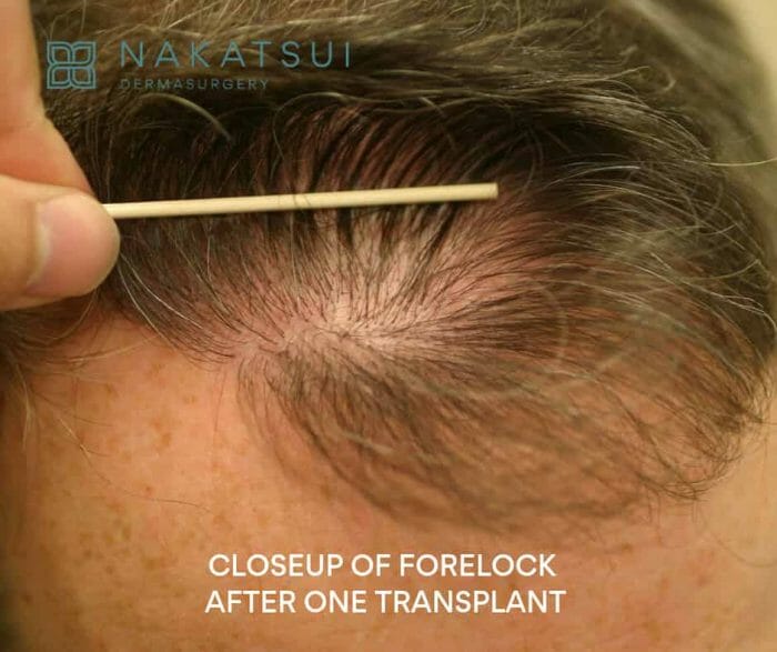 frontal forelock before and after  FUT hair transplant