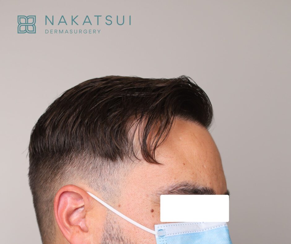 FUE Hair Transplant Edmonton right side after photo