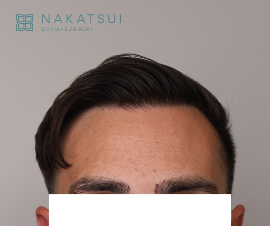 FUE Hair Transplant Edmonton front after photo