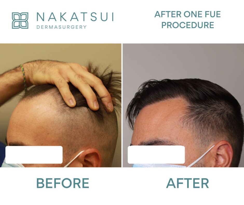 FUE Hair Transplant Edmonton before and after left side photo