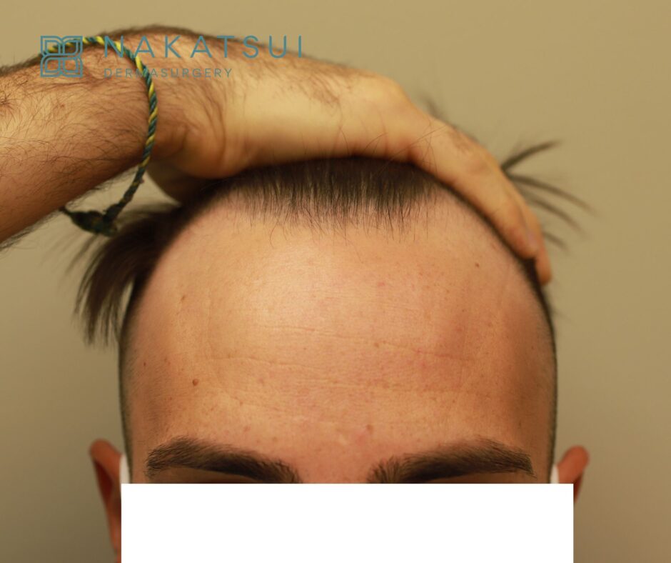 FUE Hair Transplant Edmonton before photo front