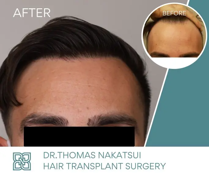 FUE hair transplant 1645 grafts before and after cover photo