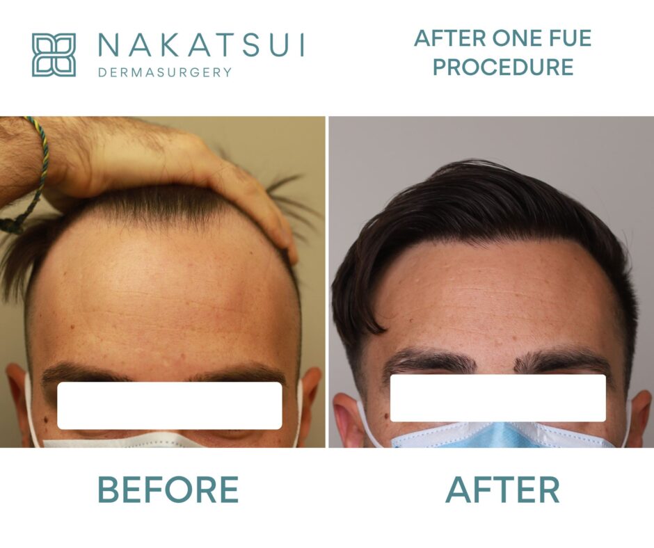 FUE hair transplant before and after front photo