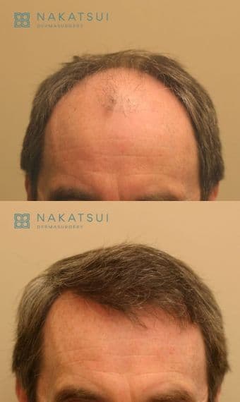 FUT frontal scalp before and after hair transplant