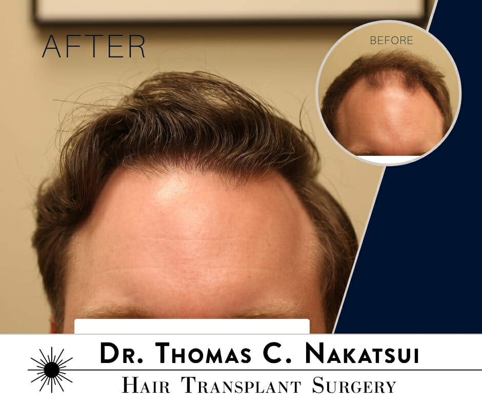 2,200 Graft Hair Transplant Surgery | Dr. Thomas Nakatsui :
