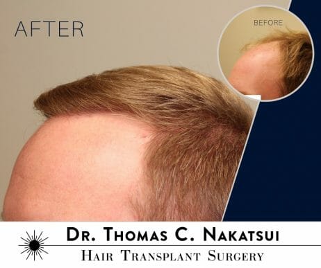 hair transplant restoration surgery follicular unit transplant extraction FUE hair loss hair growth edmonton alberta canada