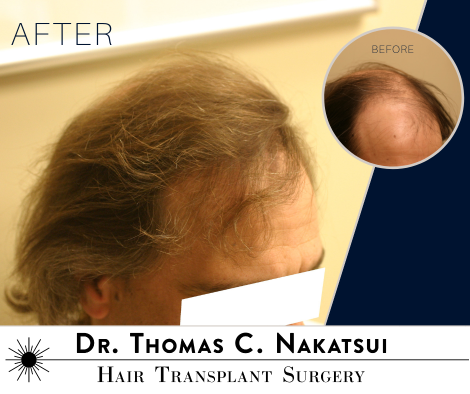 Hair Transplant Restoration Surgery Follicular Unit Extraction FUE hair loss edmonton alberta canada