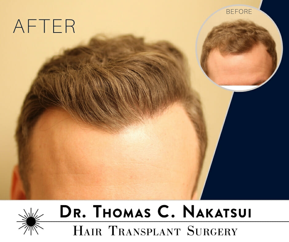 2200 Graft FUE Hair Restoration | Nakatsui Hair Transplant :