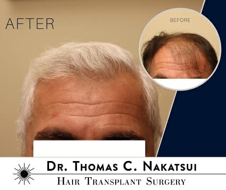 Hair Restoration Transplant Surgery Edmonton Alberta Canada Natural