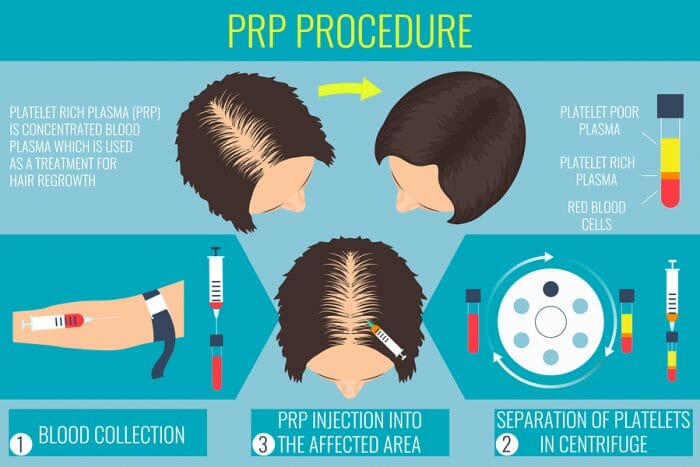 Infographic PRP Edmonton Procedure