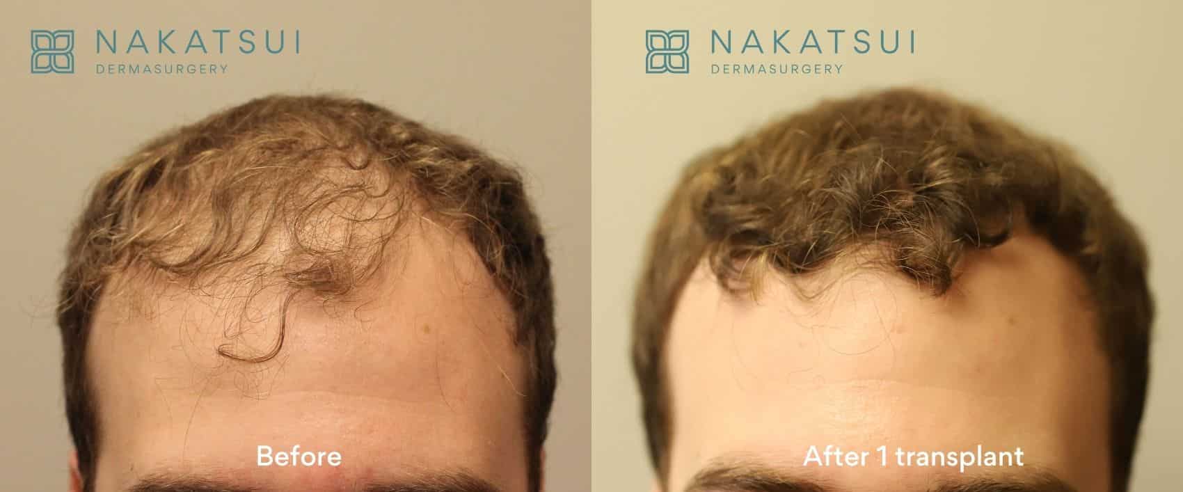 before and after hair transplant calgary