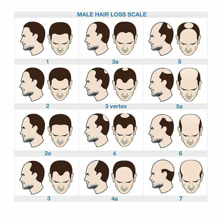 Norwood Chart Pattern Baldness