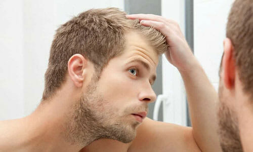 male pattern hair loss or balding