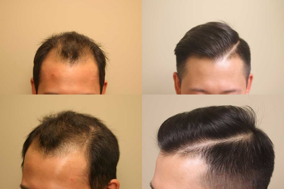 How To Fix A Messed Up Hairline - Wimpole Clinic