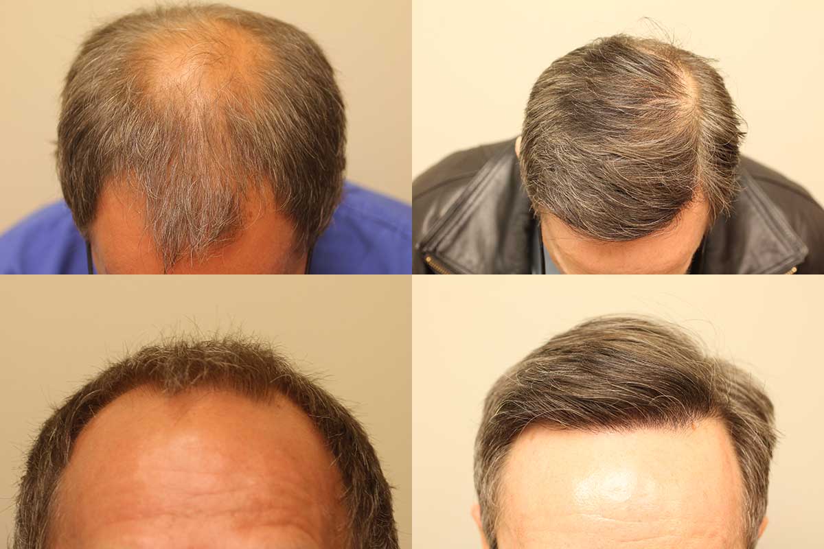 Temple Hair Loss: Why It's Happening & What You Can Do | Longevita