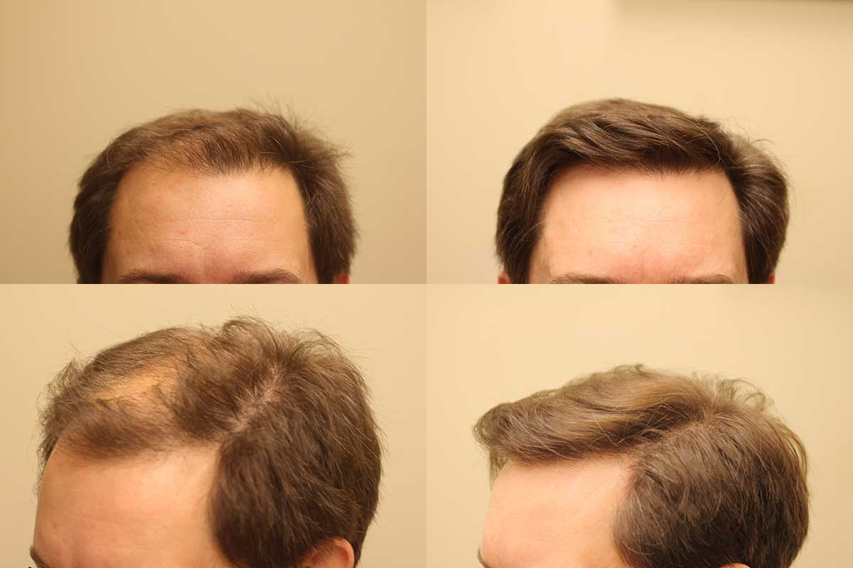 Our Hair Restoration Results | Edmonton | Nakatsui Hair Transplant :