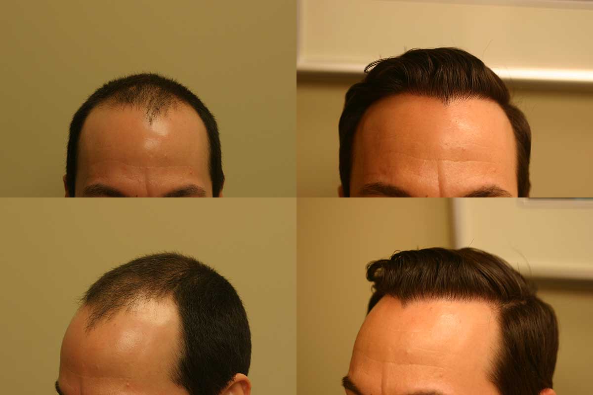 Mature Hairline: Causes, detection and prevention - RepHair