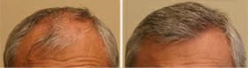 hair transplant results frontal scalp 